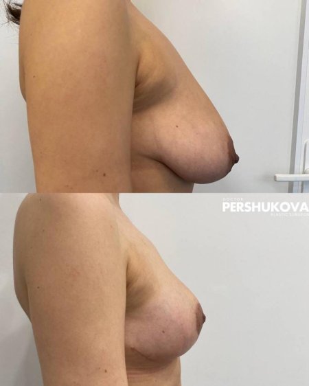 До и после увеличения груди