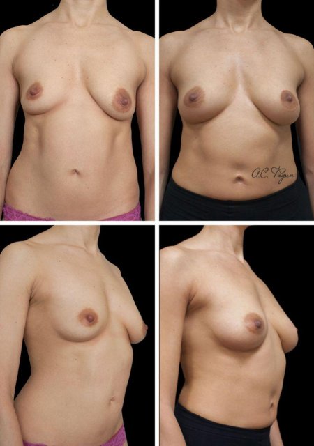 Для увеличения груди