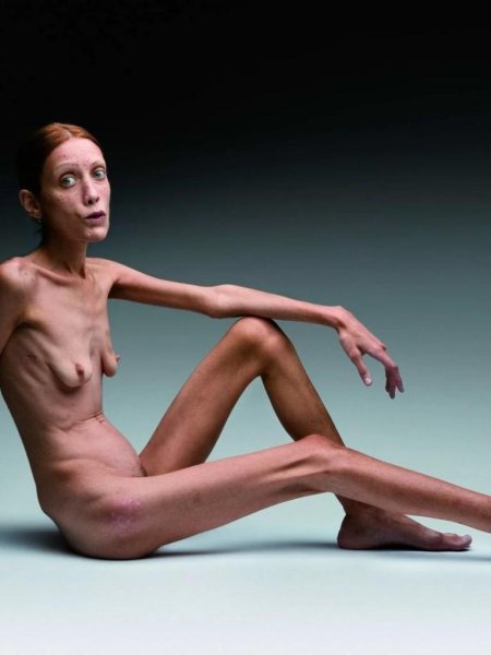 Девушки с анорексией