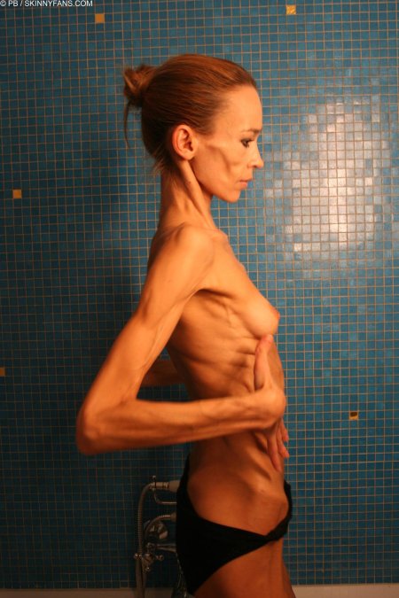 Анорексичная кахексия