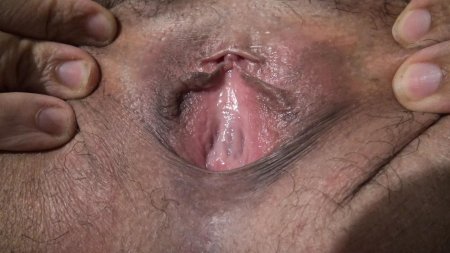 Папиллома влагалища