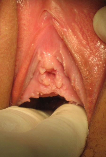 Разрастание слизистой влагалища