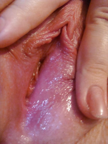 Аногенитальные кондиломы