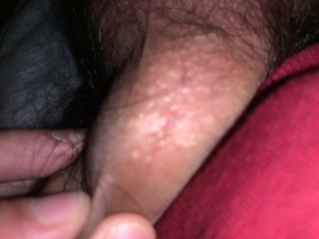 Остроконечная кондилома