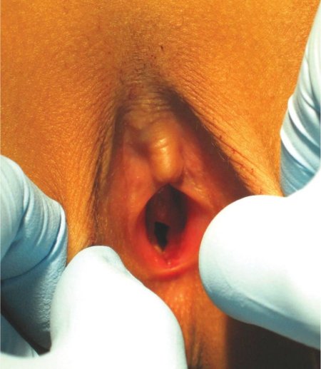 Атрезия девственной плевы