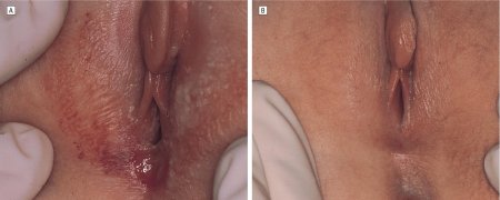 Склероатрофический лихен вульвы