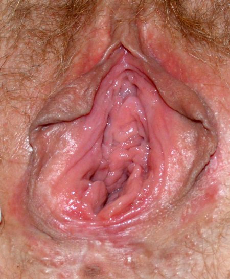 Новообразования вульвы