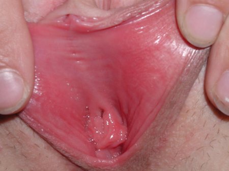 Воспаление преддверия влагалища