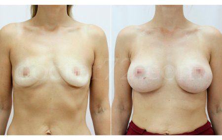 Пластика груди до и после