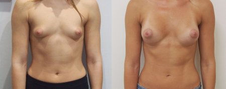 Breast reduction dr. richard