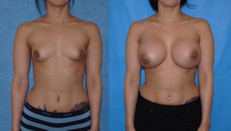 Breast augmentation