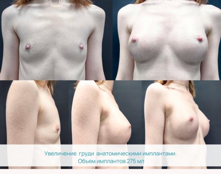 Увеличение груди анатомическими имплантами