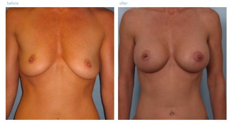 Силиконовая грудь до и после