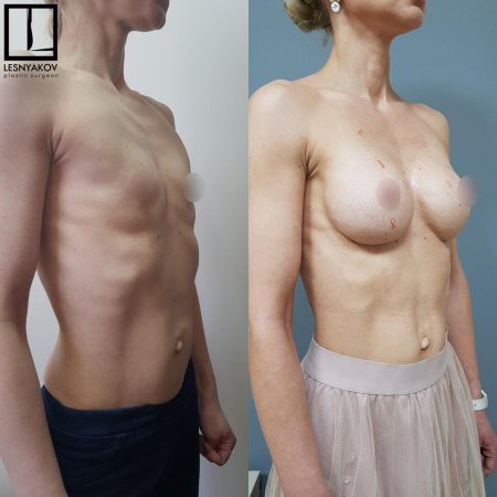 Ложная гинекомастия