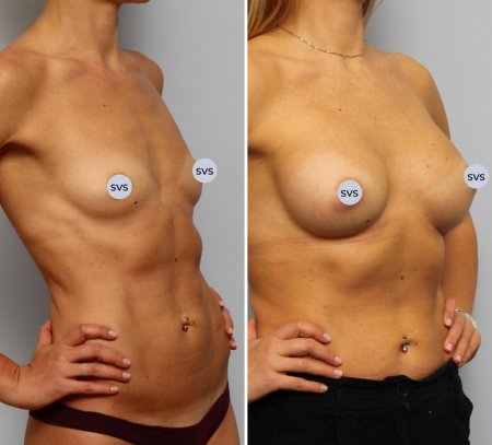 Натуральное увеличение груди