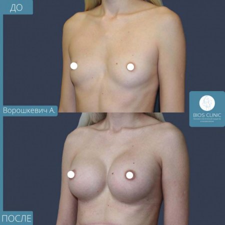 Грудь пластика