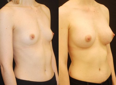 Микромастия голая грудь