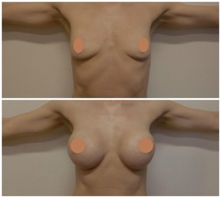 Пластика груди