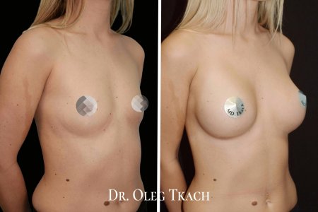 Увеличение груди имплантами