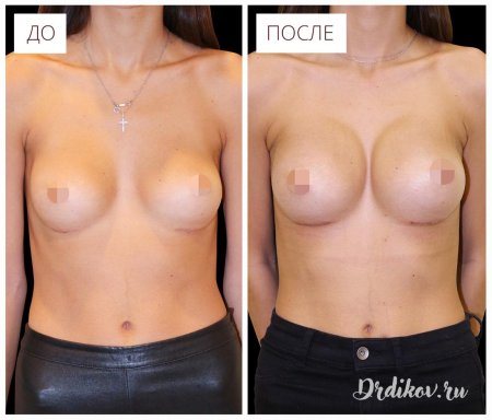 Маммопластика операция