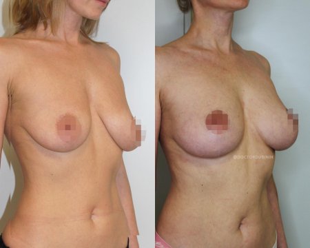 Якорная подтяжка груди