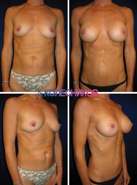 Липосакция липоскульптурирование