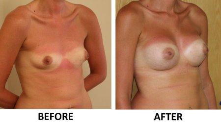 Пластика груди