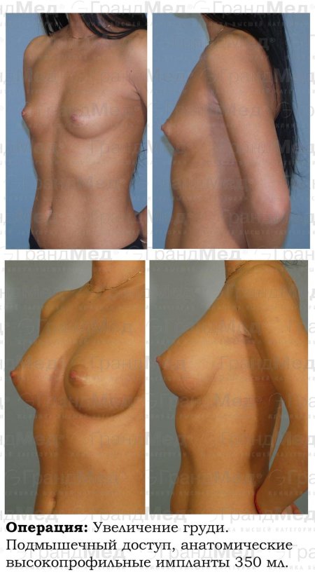 Увеличение грудных желез