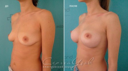 Пластика груди фото до и после