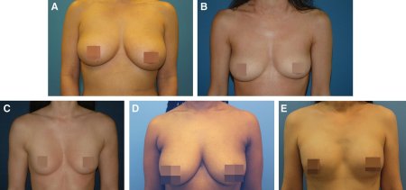 Breast augmentation