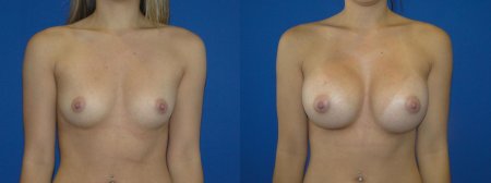 Пластика груди