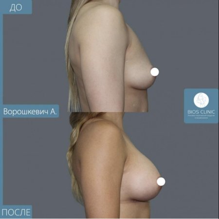 Увеличение груди анатомическими имплантами
