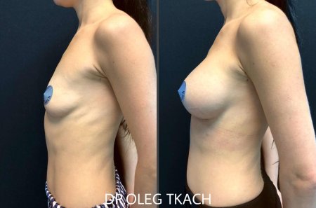 До и после увеличения груди
