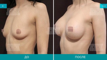 Грудь с круглыми имплантами