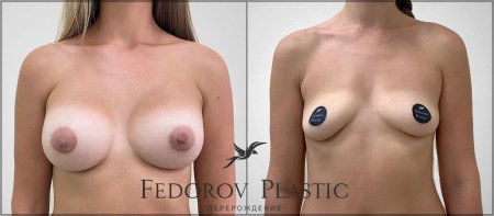 Грудь пластика