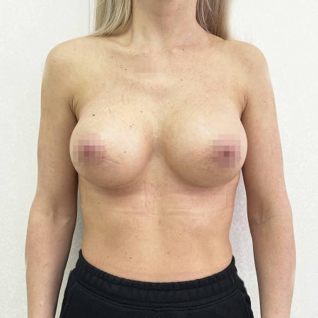 Каплевидная грудь