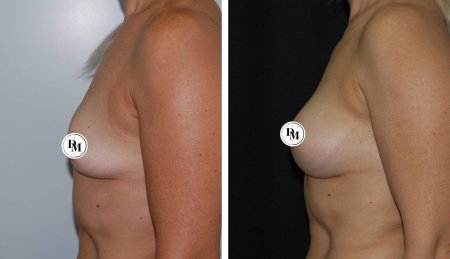 Аугментационная маммопластика