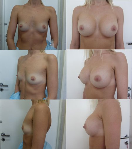Увеличение груди