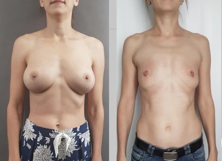 Силиконовая грудь