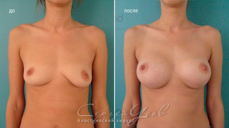 Пластика груди
