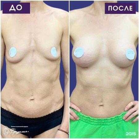 Мастопексия молочных желез