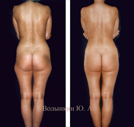 Ручная липосакция галифе