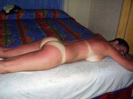 Обгорела на солнце