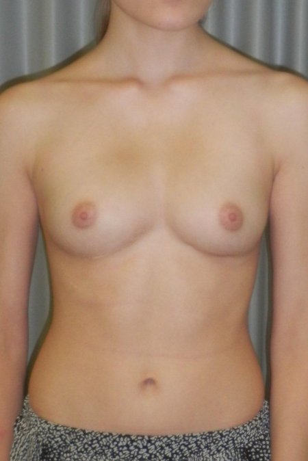 Воронкообразная грудь у девушек