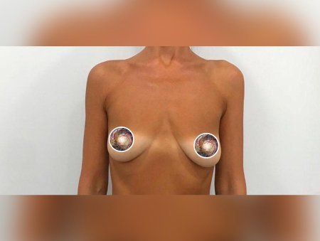 Увеличение груди имплантами