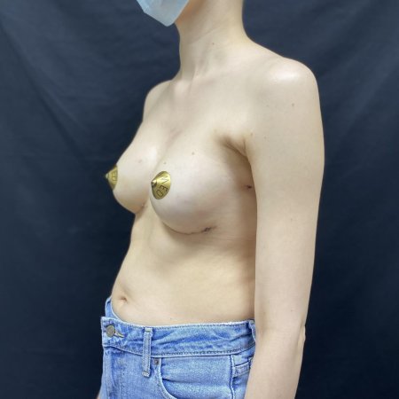 Тотальная мастэктомия