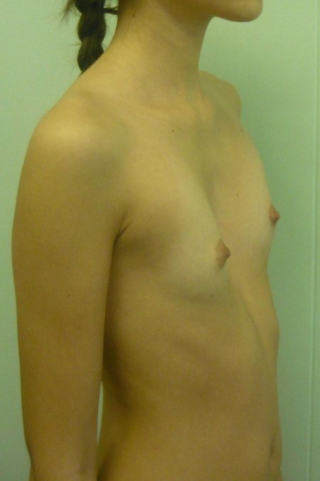 Килевидная грудная клетка