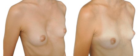 Воронкообразная деформация грудной клетки