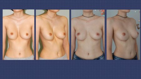 Маммопластика при воронкообразной деформации