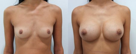 Красивая грудь с имплантами